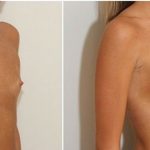 mastoplastica additiva